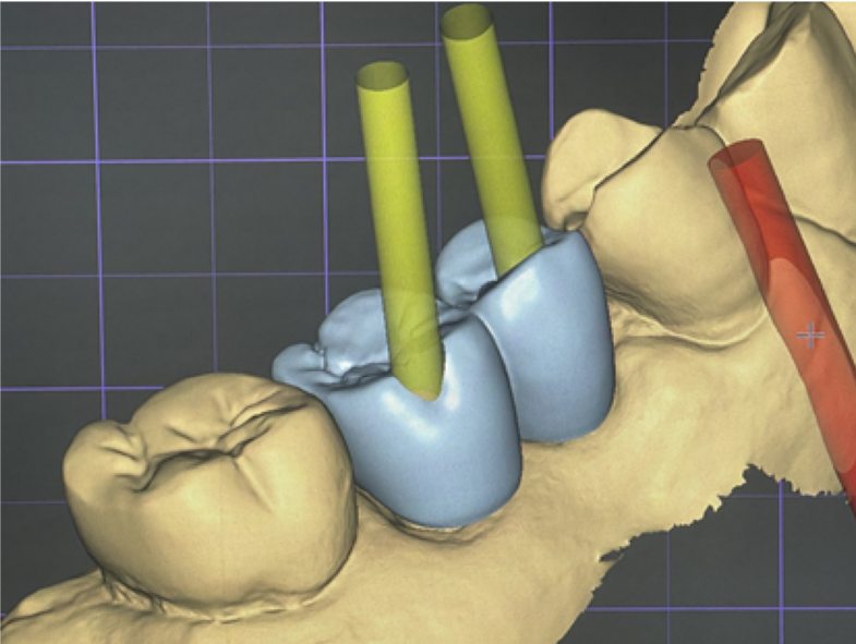 고덕동치과 서울바르디치과 전치부 및 구치부 임플란트 치료증례 #9 관련 이미지 35
