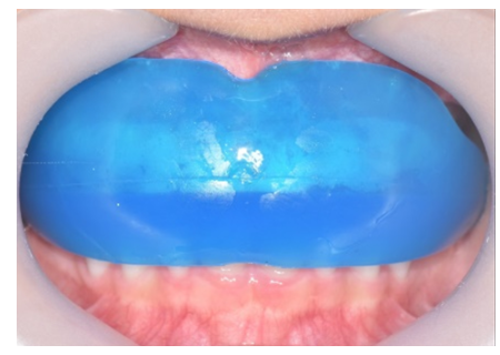 아이 프리올소 장치 어떤 치료인가요? 관련 이미지 5