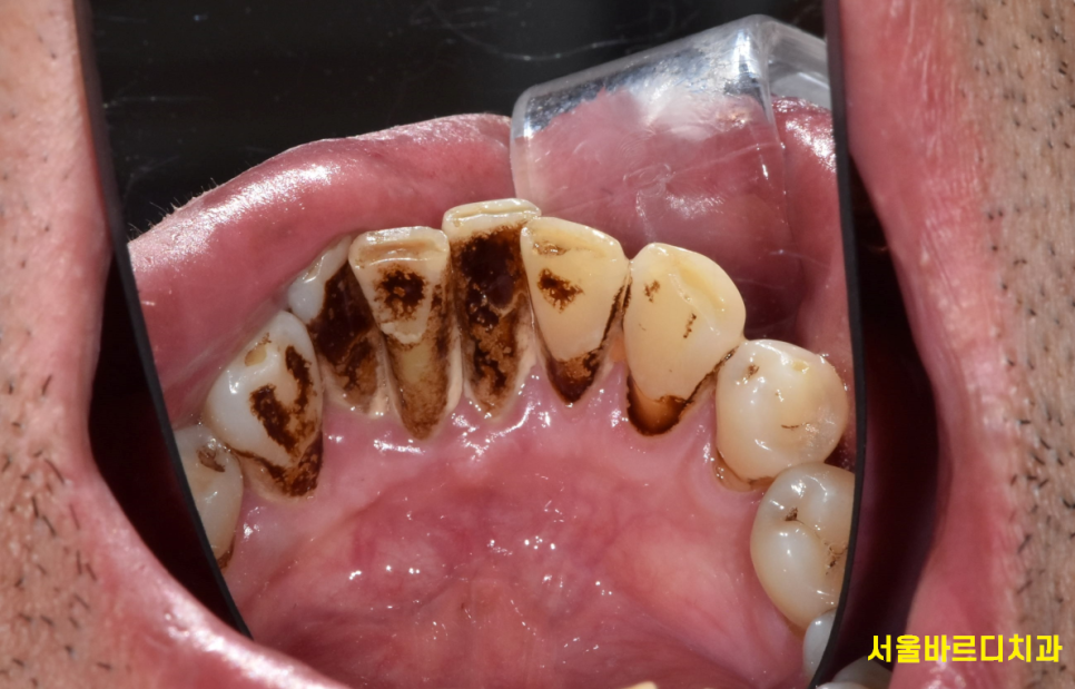 임플란트 시술 성공률, 얼마나 높을까? 처음 하시는 분들께 관련 이미지 3