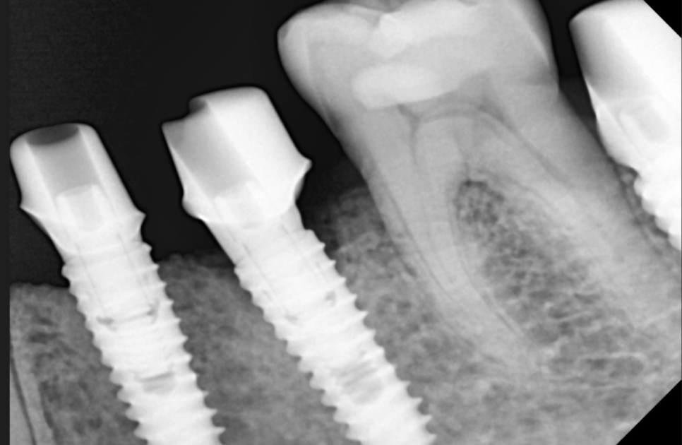 망월동 치과 어금니 빠짐 임플란트 대안이 될 수 있습니다. 관련 이미지 9
