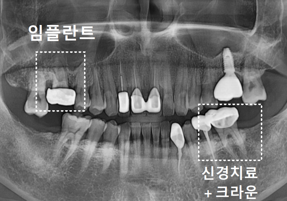 상일역 치과, 오래된 금니 빠짐, 같은 증상으로 내원했지만 전혀 다른 결과, 그 차이는? 관련 이미지 1