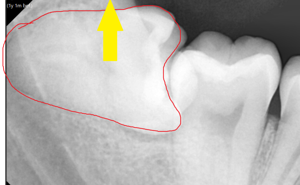 상일동 사랑니 발치  시간, 비용 절약하는 3가지 꿀팁 공개~! 관련 이미지 3