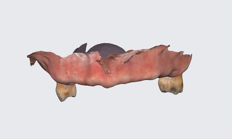 암사동 치과 전악 임플란트 하루만에 끝냈습니다. 관련 이미지 6