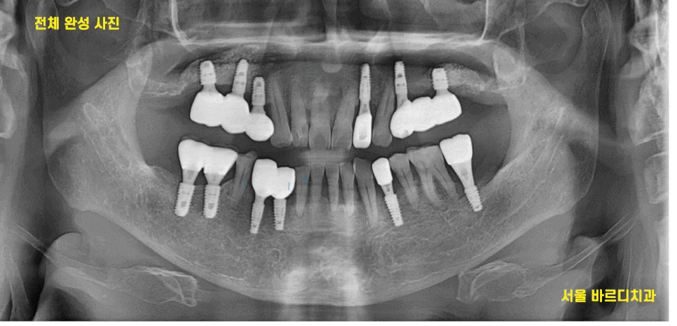 상일동역 근처 치과 타원 임플란트 제거 후 재식립 케이스 관련 이미지 1