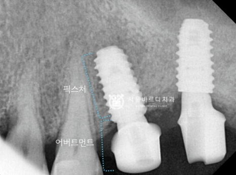 고덕동치과 서울바르디치과 무절개 네비게이션 임플란트 치료증례 #1 관련 이미지 15
