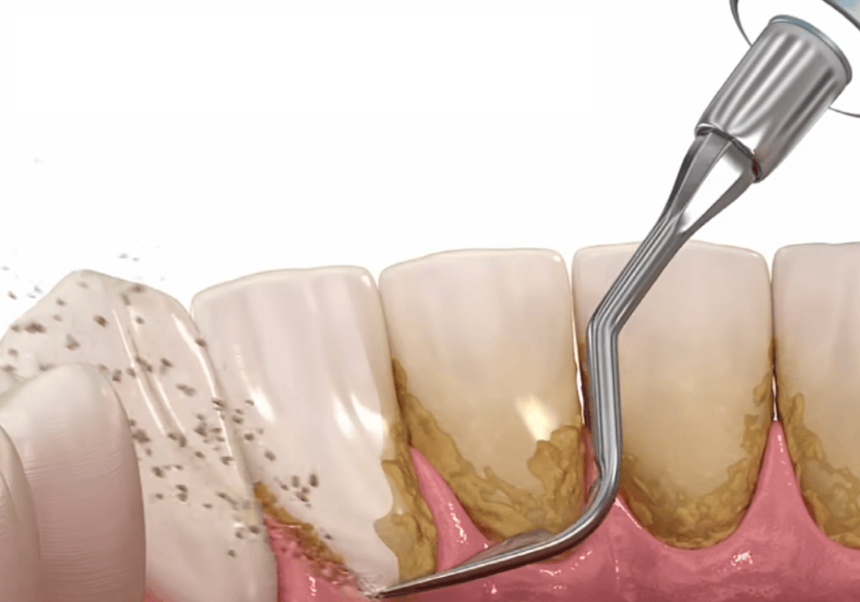 스케일링했더니 잇몸 구멍, 치아 사이 구멍이 생겼어요. 스케일링에 관한 오해 3가지 관련 이미지 5