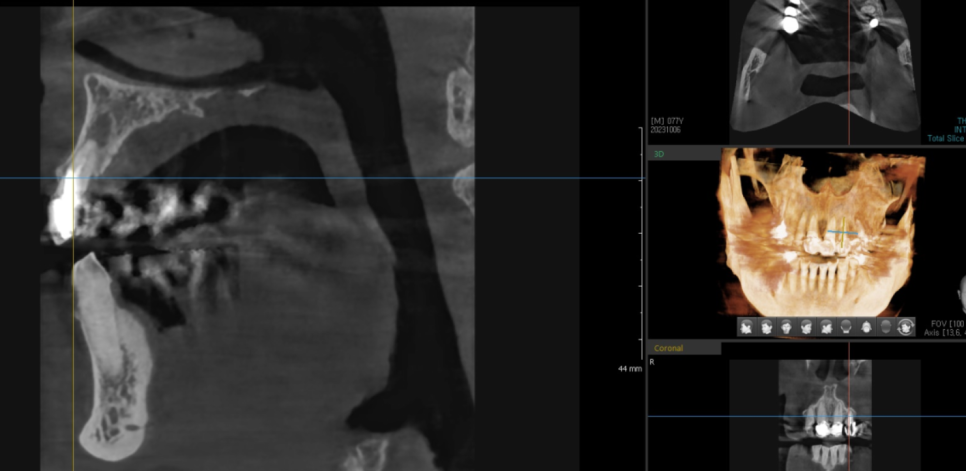 아스피린 복용 중인데 임플란트 수술, 가능할까요? 아스피린 얼마나 끊어야 하나요? 관련 이미지 7