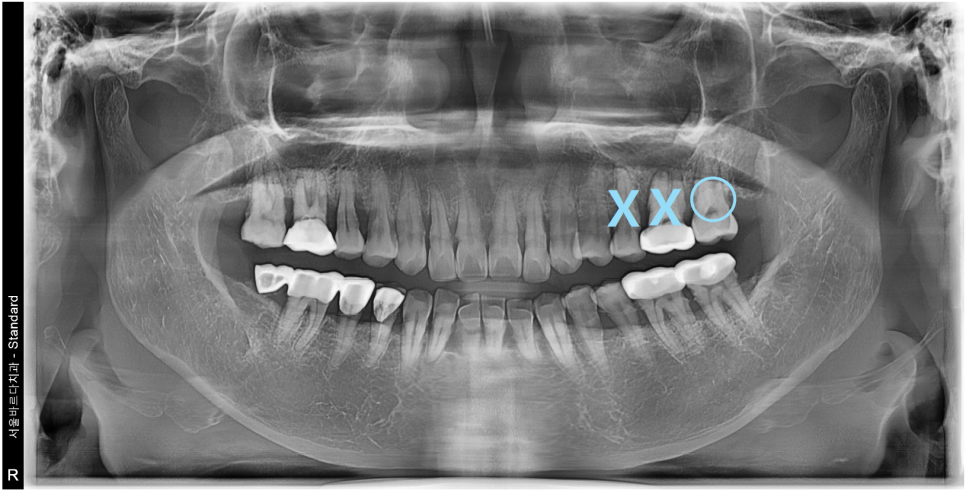 고덕동치과 서울바르디치과 무절개 네비게이션 임플란트 치료증례 #2 관련 이미지 8