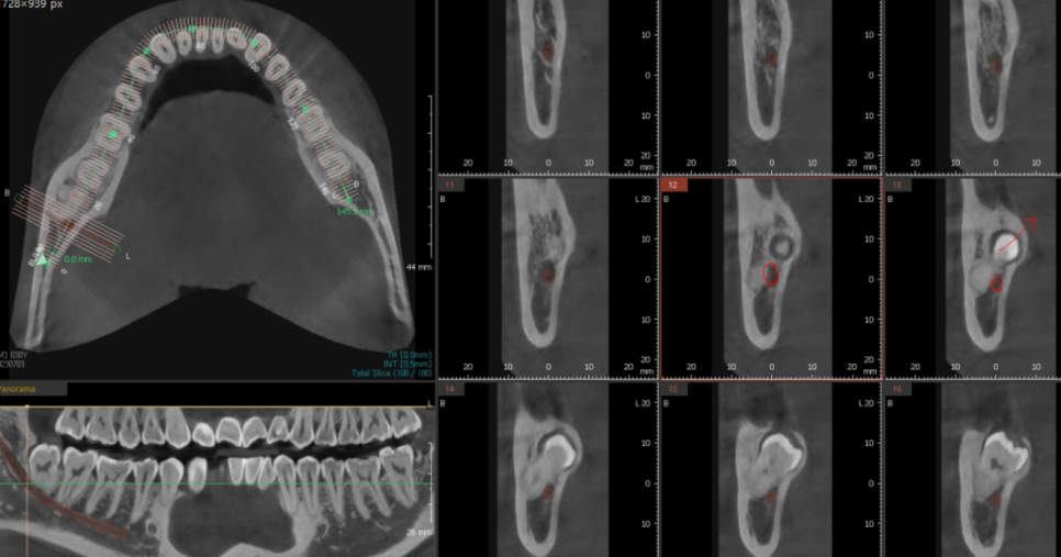 상일동 사랑니 맨날 뽑아야지는 그만!! 매복 치아도 깔끔하게 뽑으세요 관련 이미지 6