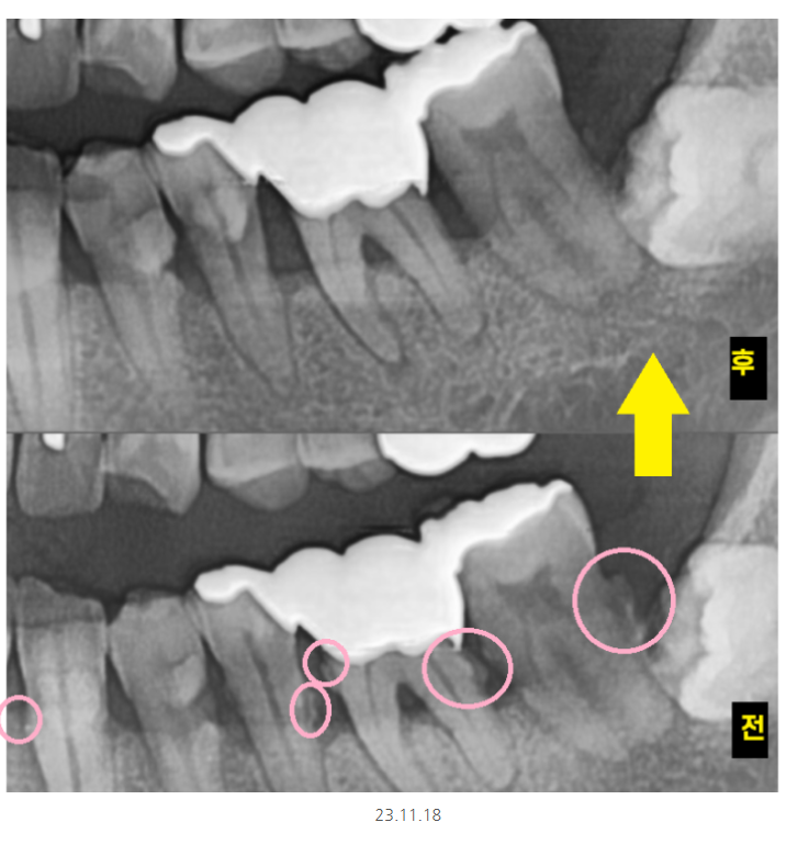 강일동 치과추천 어금니 시림 방치하다 발치하고 임플란트 하신 사연 관련 이미지 7