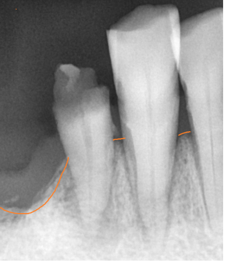 외국인 치과 진료 하악 전체 임플란트 7개 심어 12개 치아 만들기 관련 이미지 5