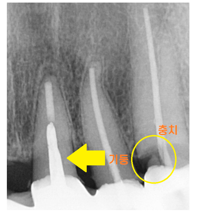 상일동 치과 충치로 인한 앞니 브릿지 파절 재건해보았습니다. 관련 이미지 6
