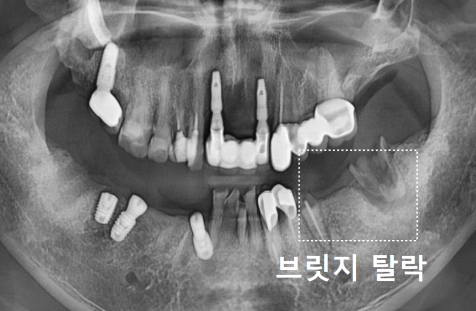 오래된 어금니 롱브릿지, 교체 타이밍을 놓치면 관련 이미지 11