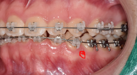 Answering Your Questions About Orthodontic Mini-Screw Placement. (Q&A) image 6