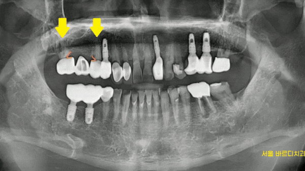 예전에 씌운 이 상악동 거상술 뼈이식 동반하여 임플란트 완료 관련 이미지 1