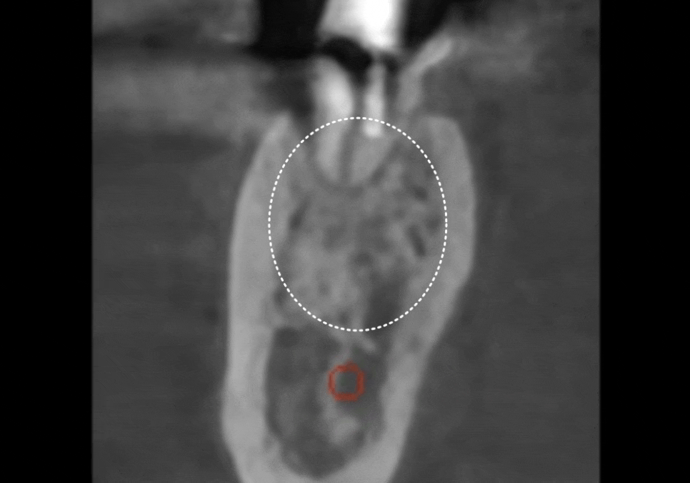 강동구 임플란트 기간, 사람마다 왜 다를까? 즉시식립과 지연식립의 결정적 차이 관련 이미지 18