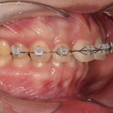 Gangdong-gu Orthodontic Dentistry: I Heard Orthodontic Treatment Causes Tooth Roots to Dissolve? image 2
