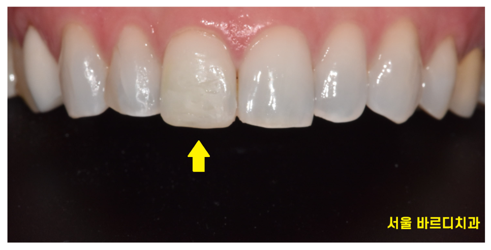 살짝 깨진 앞니 레진과 라미네이트 갈림길 어떤게 더 좋을까? 관련 이미지 4