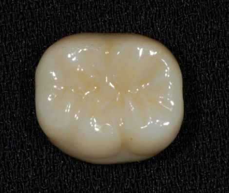 천호동 치과 임플란트 크라운 종류 설명 나갑니다. 관련 이미지 9