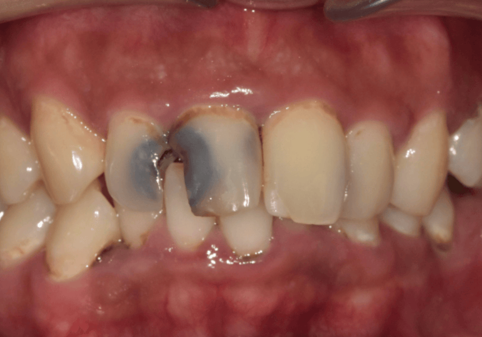 A Single Black Spot of Decay Between the Front Teeth May Be a Warning Sign of Multiple Cavities. image 14