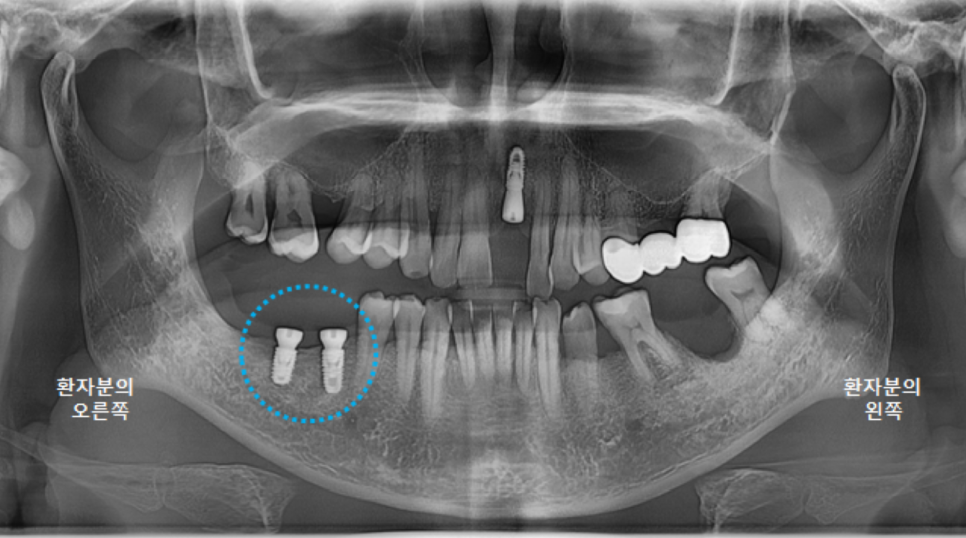 고덕동치과 서울바르디치과 전치부 및 구치부 임플란트 치료증례 #9 관련 이미지 6