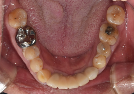 뼈가 없어서 안 된다구요? 70대 당뇨 무치악 환자분의 전체 임플란트 사례 관련 이미지 2