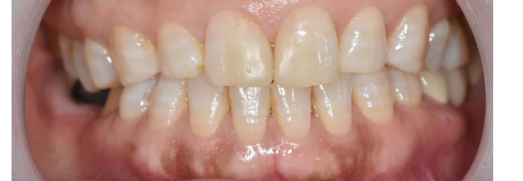 고덕동 교정 치과 성인 덧니 교정 지금도 늦지 않았습니다. 관련 이미지 5