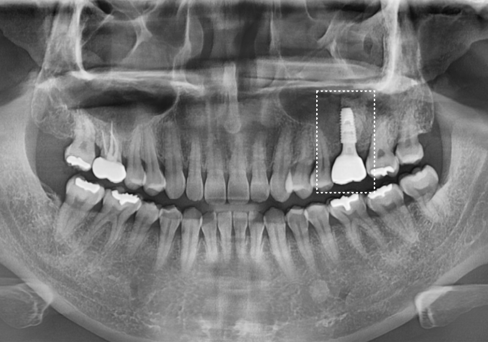 Sinusitis Caused by Teeth: Why Do You Tell Me to Go to the Dentist When My Nose Hurts? image 15