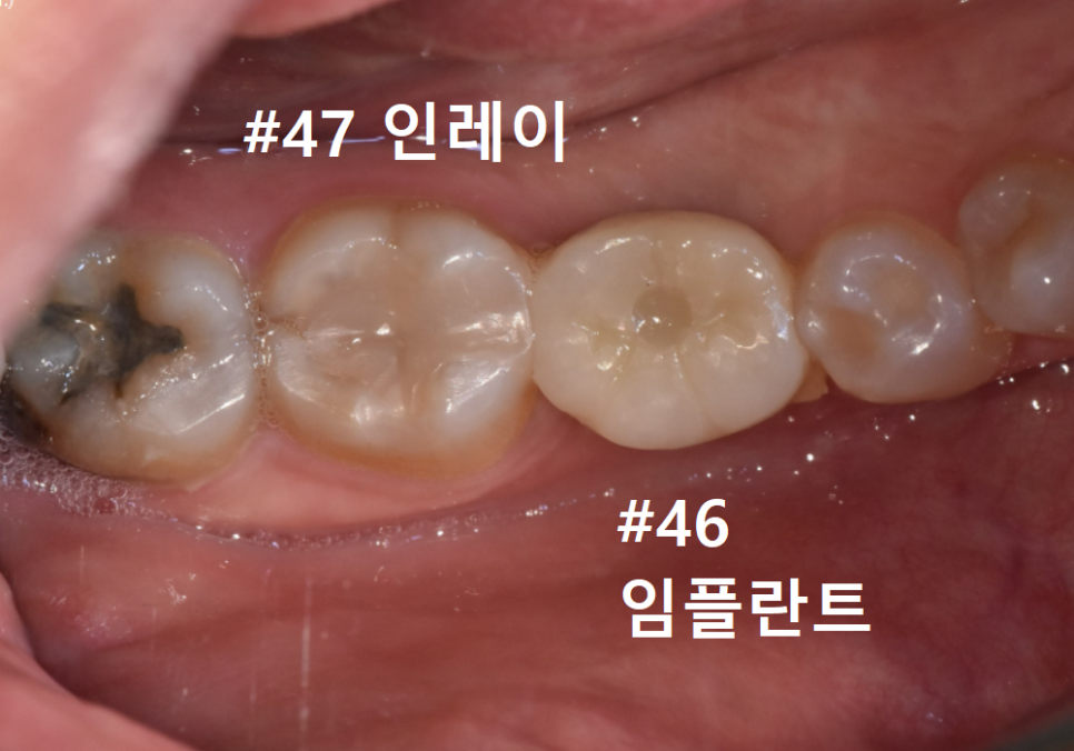 고덕동 어금니 사이 충치, 양치질 누구보다 열심히 하는데 왜 자꾸 생길까요? 관련 이미지 14