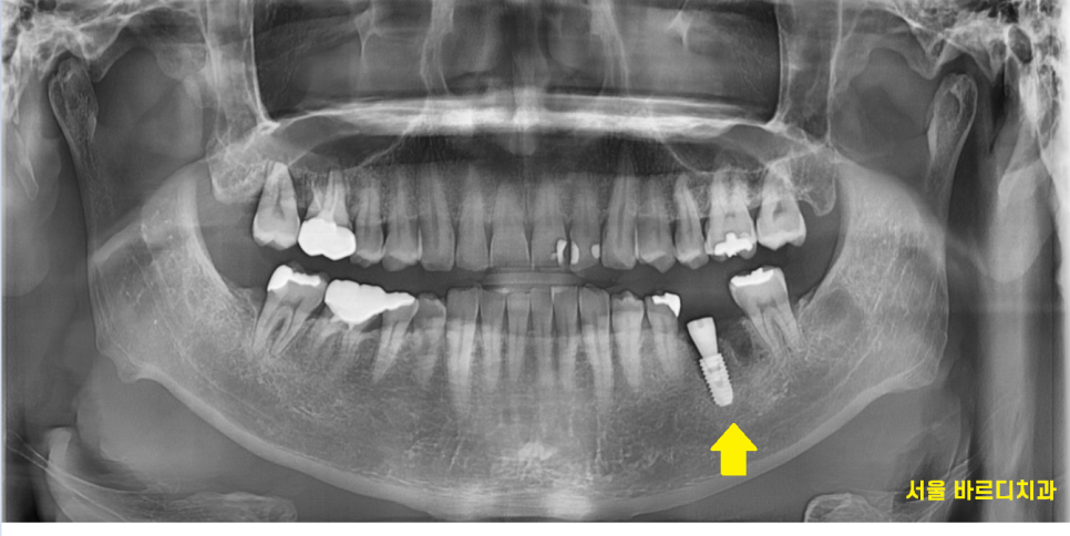 고덕역 치과 치아뿌리 파절 부러짐 있을 때 임플란트로 대체해야죠 관련 이미지 7