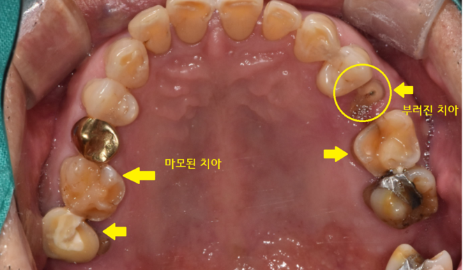강일동 치과 치아 부러짐 붙일 수 있을까요?? 관련 이미지 2