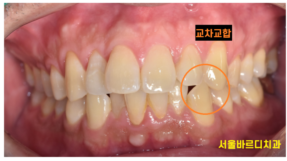고덕동 교정치과 부정교합은 무엇인가요? 어떨때 치료가 필요한가요? 관련 이미지 7