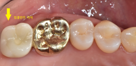 미사역 치과 어금니 뿌리 쪼개짐으로 발치 후 임플란트 했습니다! 관련 이미지 8