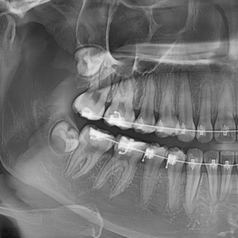 Gangdong-gu Orthodontic Dentistry: I Heard Orthodontic Treatment Causes Tooth Roots to Dissolve? image 3