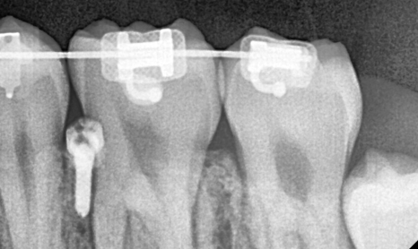 Answering Your Questions About Orthodontic Mini-Screw Placement. (Q&A) image 7