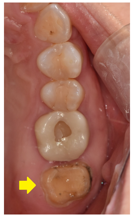 치아 크라운 빠짐 내부 충치가 심할때는 임플란트가 필요합니다. 관련 이미지 5