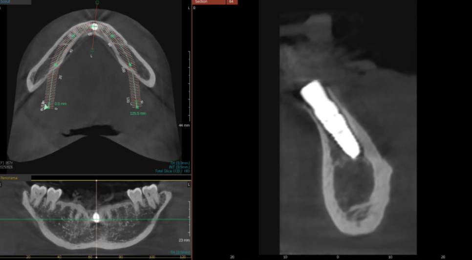 고덕동 아래 앞니 임플란트 비용 줄이는 비법, 공개합니다. 관련 이미지 9