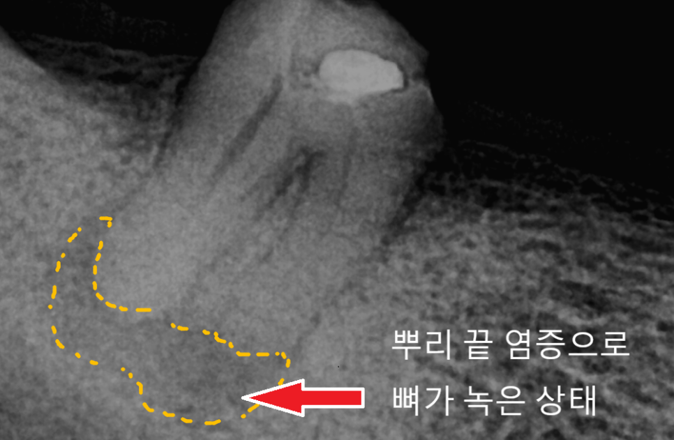 고덕역 임플란트, 뼈이식 꼭 해야 할까? 필수 상황 vs 제외 상황 총정리 관련 이미지 3
