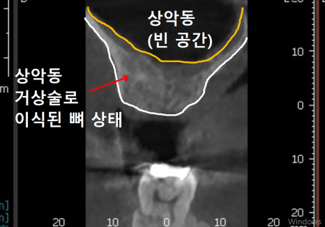 강동구 잇몸 퇴축으로 뿌리 드러난 치아, 이대로 둬도 괜찮을까? 관련 이미지 14