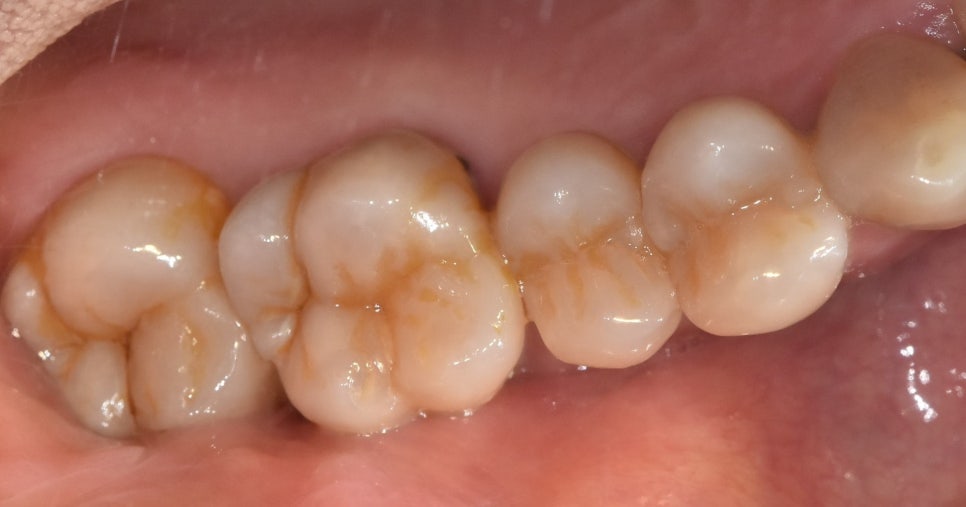 Gangdong-gu Dental Clinic: I Gag So Easily That I’m Too Afraid to Go to the Dentist. Tips to Reduce Gagging image 6