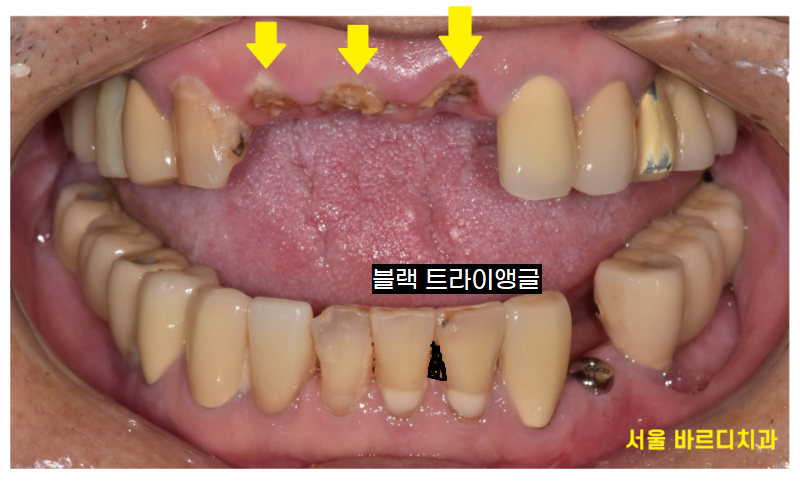 천호동 임플란트 앞니가 왜 어렵다는거죠? 수술이 안된다는데... 관련 이미지 3