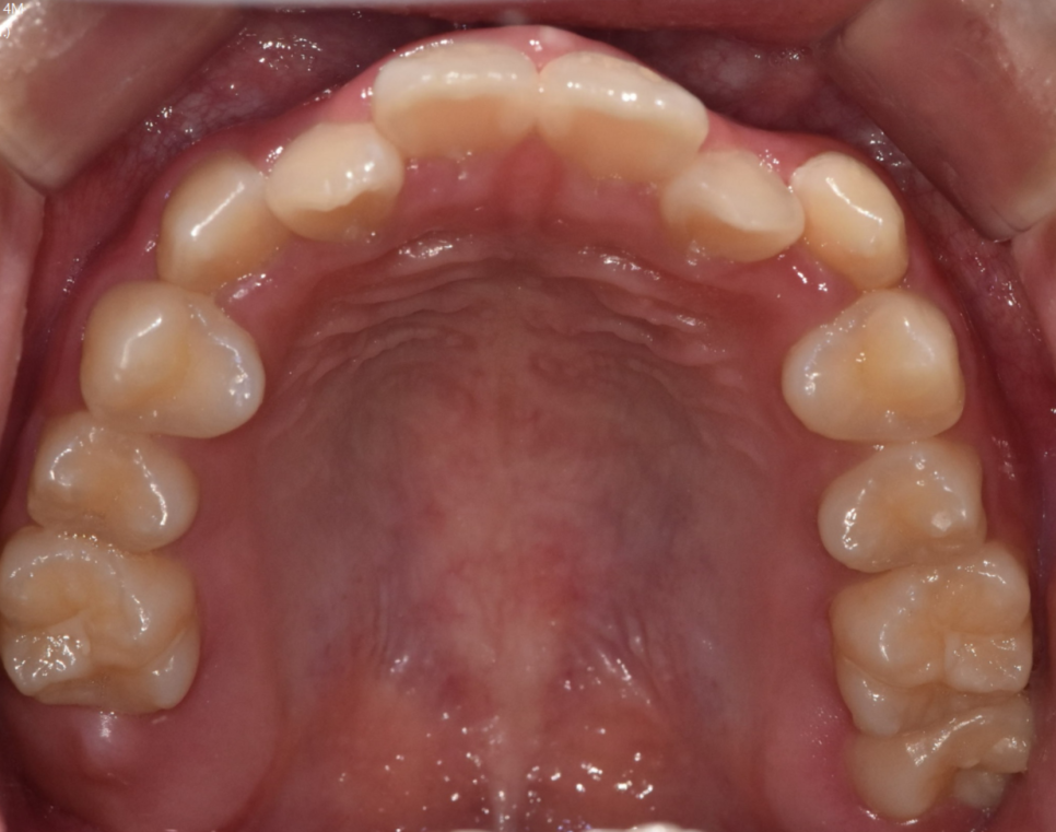 교정 중 충치 치료 먼저? 계속 방치? 알려드립니다. 관련 이미지 1