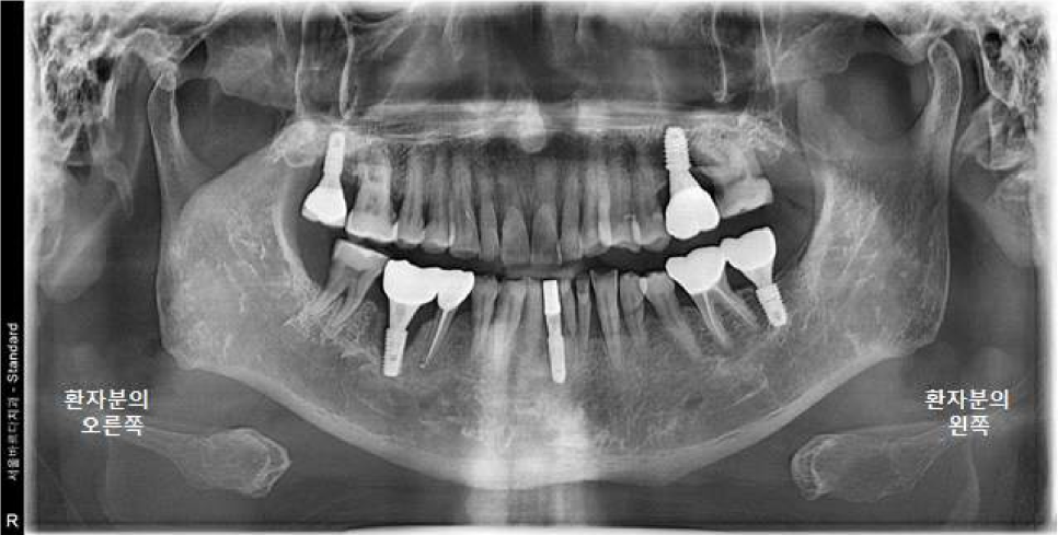 서울바르디치과 상하악 대구치 네비게이션 임플란트 치료증례 #4 관련 이미지 22
