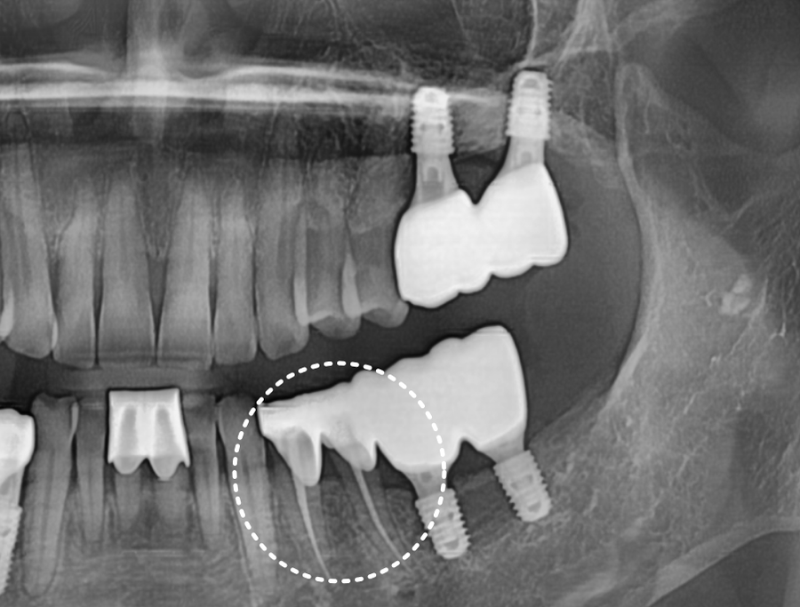고덕동치과 임플란트 정기검진, 미루다가 수십만 원 손해 봅니다. 관련 이미지 9