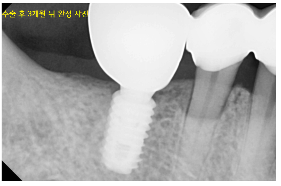 오래된 브릿지 보철 제거 후 고덕역 임플란트 교체 케이스 관련 이미지 8