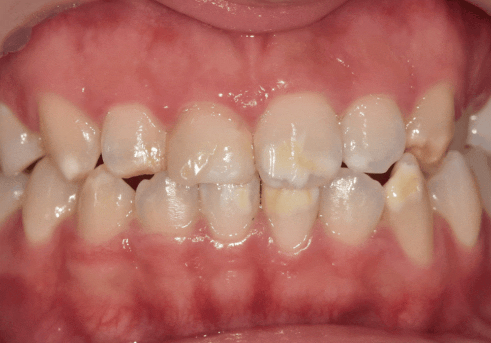 고덕역 치과 반점치 얼룩덜룩한 치아, 치료 실패 줄이는 5가지 기준 관련 이미지 3