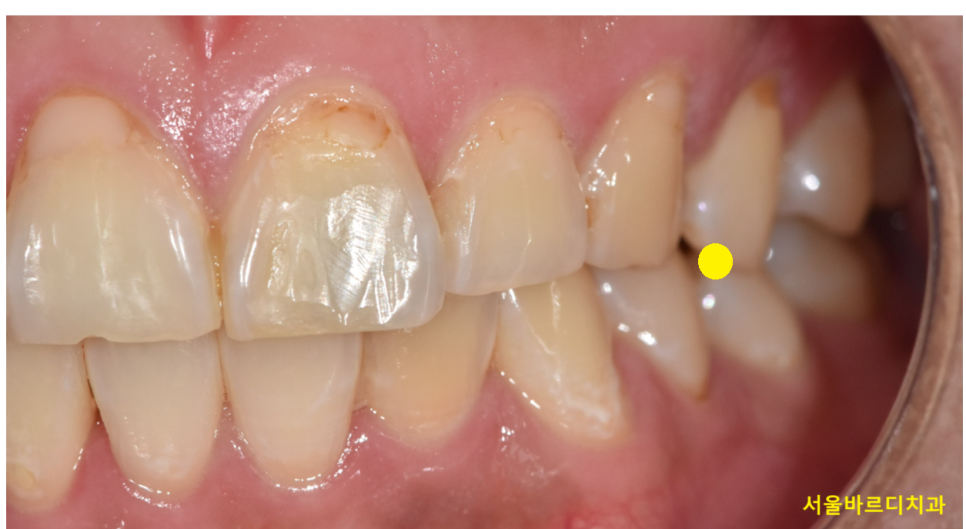 충치치료 후 이시림 자연스러운 반응일까 후유증일까? 관련 이미지 4