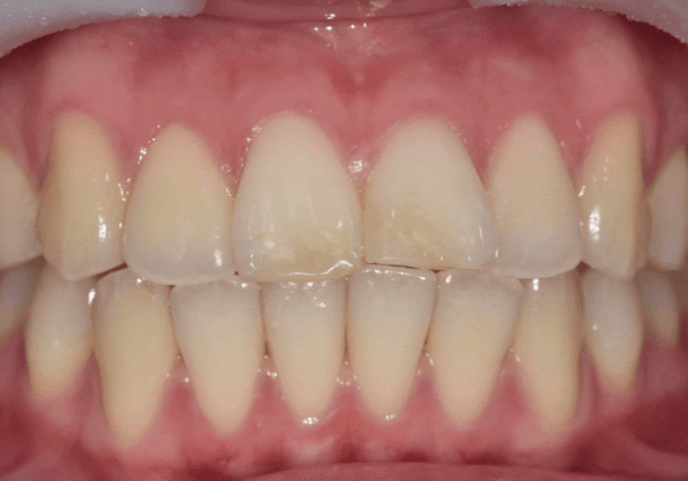 절단교합으로 인한 앞니 레진 깨짐, 교정 없이 해결한 사례 관련 이미지 4