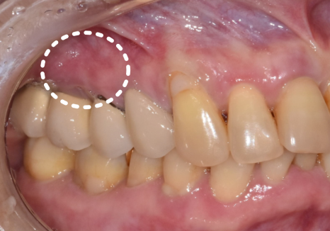 잇몸 고름 눌러보니 푹... 임플란트 주위염 방치했다가 재수술한 사례 관련 이미지 2