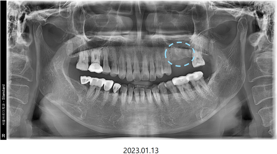 고덕동치과 서울바르디치과 무절개 네비게이션 임플란트 치료증례 #2 관련 이미지 12